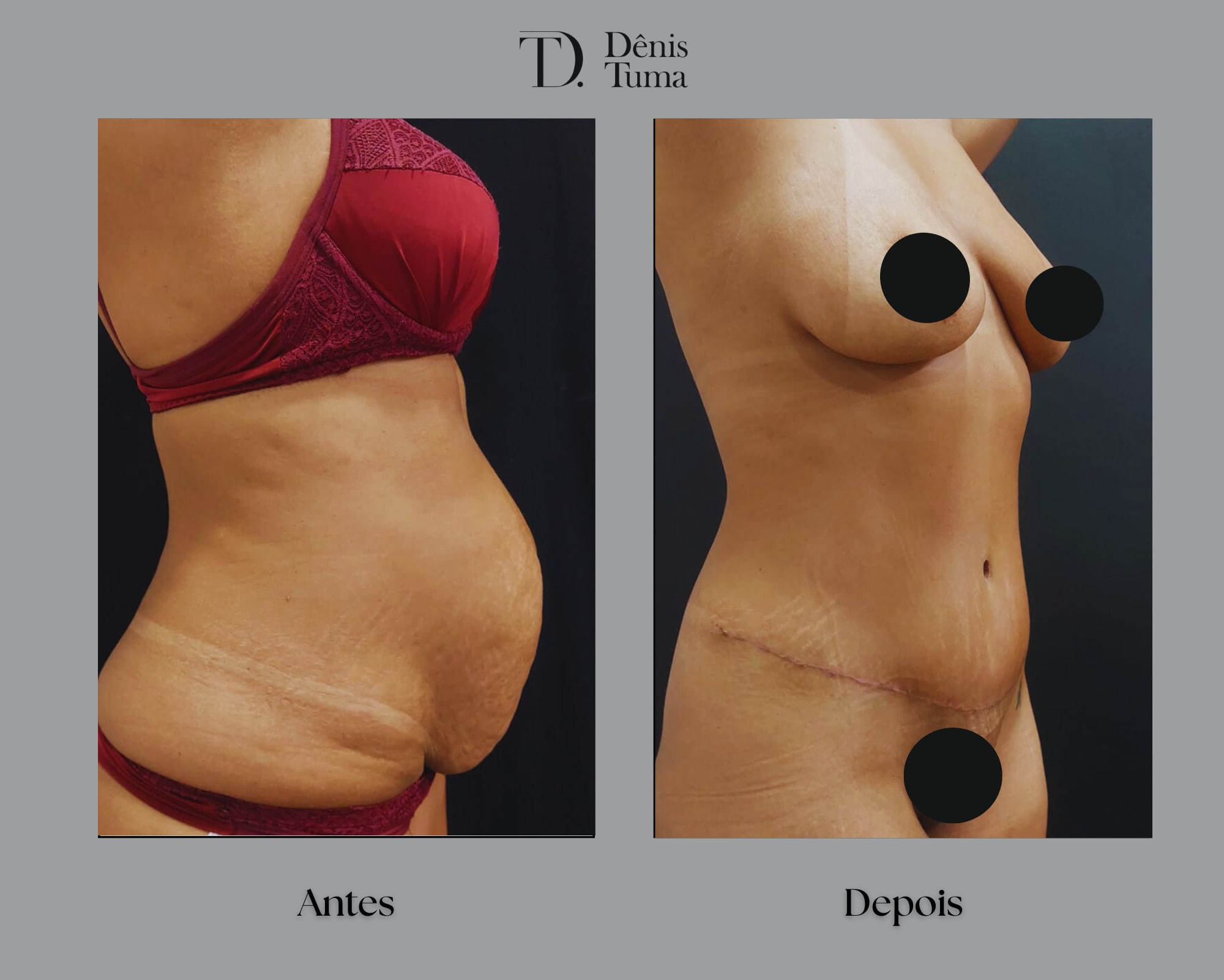 Resultado Abdominoplastia 2-min