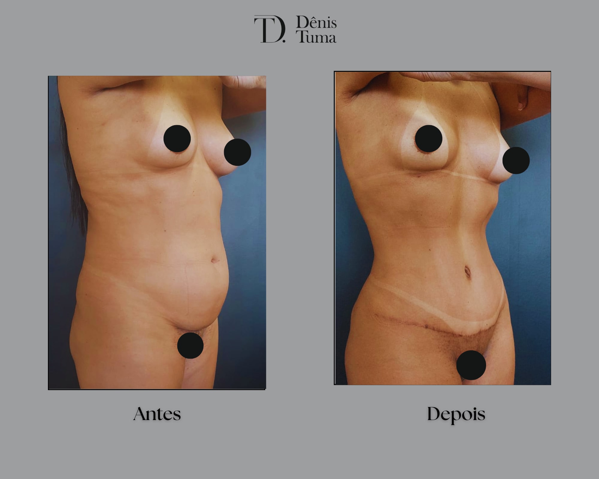 Resultado Abdominoplastia-min